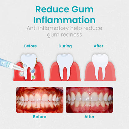 🔥Last Day Promotion 80% OFF-LOVILDS™ Gum Shield Therapy Gel