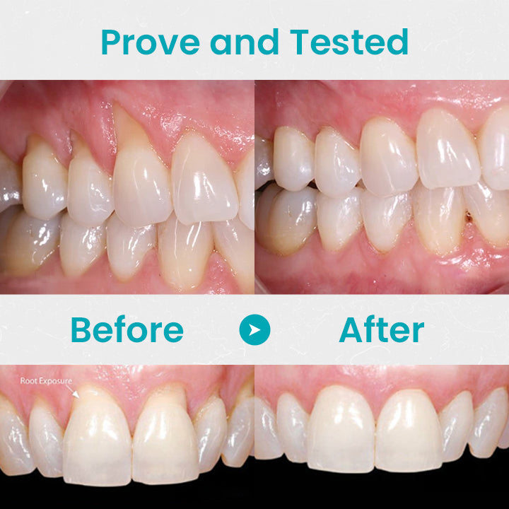 🔥Last Day Promotion 80% OFF-LOVILDS™ Gum Shield Therapy Gel